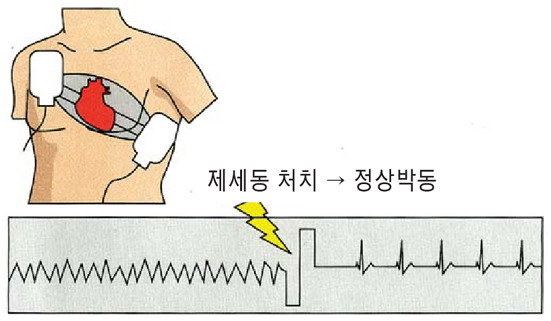 자동제세동기 원리