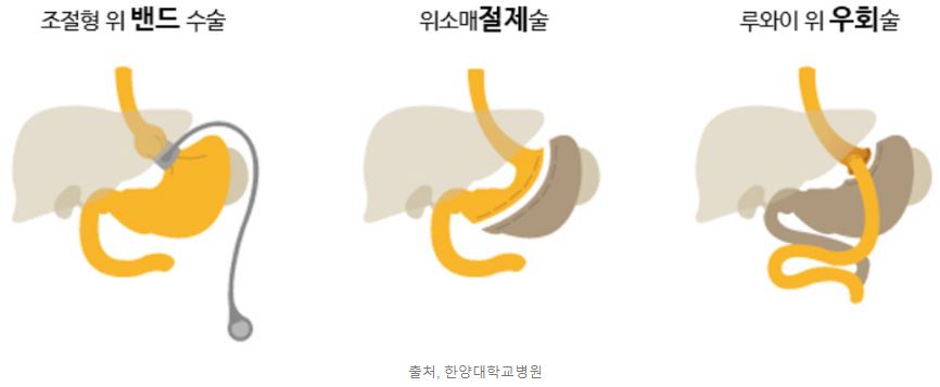 고도비만