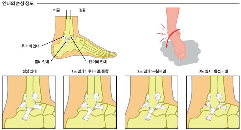 발목 접질림