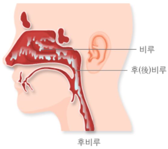 비염